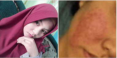 jerawat parah sembuh diabetes total
