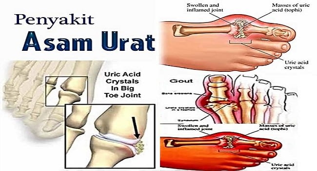 Penyakit Asam Urat Asam Urat Jenis Diagnosis Penyebab dan Pengobatannya 