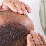 Terapi Pengobatan Rambut Rontok Dengan Produk Herbal HNI HPAI