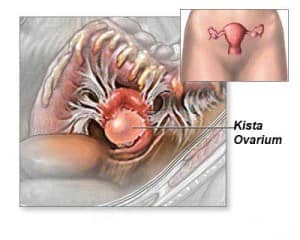 gambar penyakit kista ovarium